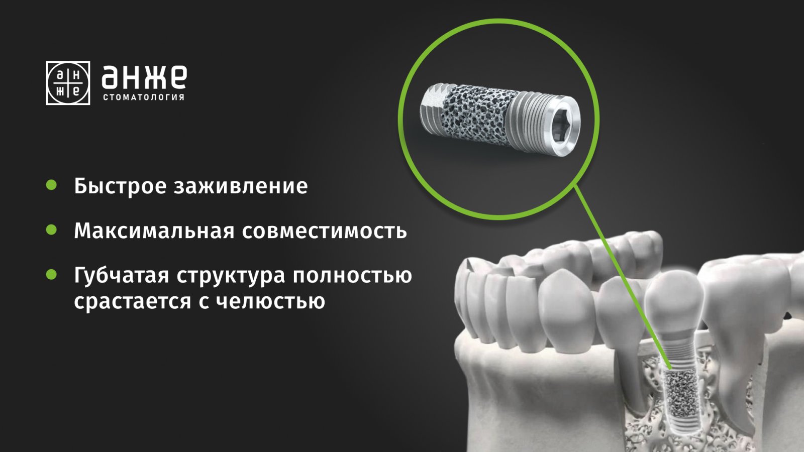 Два варианта креативов для услуги «Трабекулярная имплантация». В текст вынесены основные преимущества для пациентов. Изображение наглядно иллюстрирует процесс имплантации и показывает инновационность имплантатов через трендовую картинку. статья